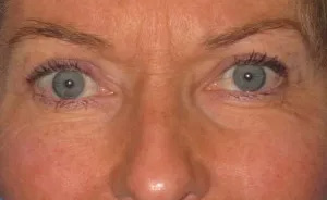 Eyelid Surgery Real Patient Results by Dr. Scott Urban in Salt Lake City, Utah