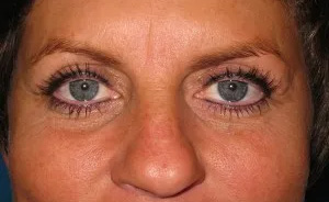 Eyelid Surgery Real Patient Results by Dr. Scott Urban in Salt Lake City, Utah