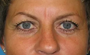 Eyelid Surgery Real Patient Results by Dr. Scott Urban in Salt Lake City, Utah