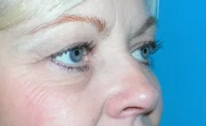 Eyelid Surgery Real Patient Results by Dr. Scott Urban in Salt Lake City, Utah
