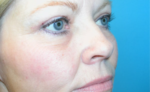 Eyelid Surgery Real Patient Results by Dr. Scott Urban in Salt Lake City, Utah