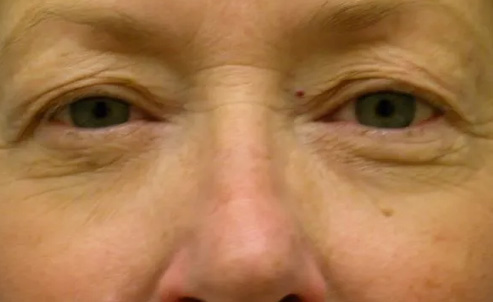 Eyelid Surgery Real Patient Results by Dr. Scott Urban in Salt Lake City, Utah