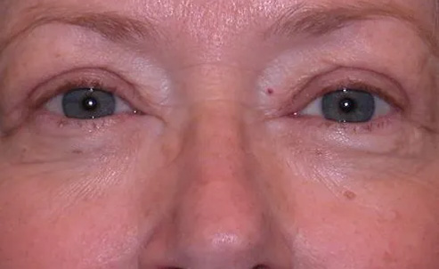 Eyelid Surgery Real Patient Results by Dr. Scott Urban in Salt Lake City, Utah