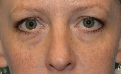 Eyelid Surgery Real Patient Results by Dr. Scott Urban in Salt Lake City, Utah