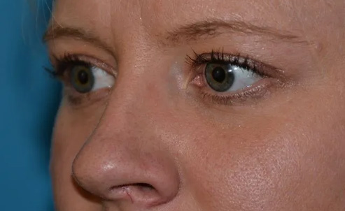 Eyelid Surgery Real Patient Results by Dr. Scott Urban in Salt Lake City, Utah