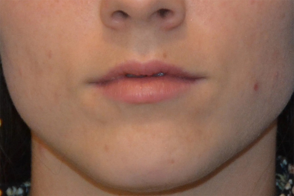 Facial Filler Real Patient Results by Dr. Scott Urban in Salt Lake City, Utah