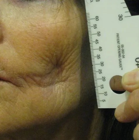 Facial Filler Real Patient Results by Dr. Scott Urban in Salt Lake City, Utah