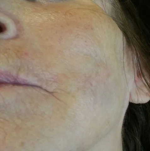 Facial Filler Real Patient Results by Dr. Scott Urban in Salt Lake City, Utah