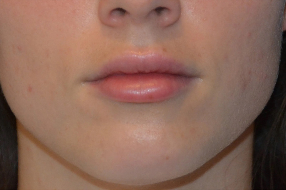 Facial Filler Real Patient Results by Dr. Scott Urban in Salt Lake City, Utah
