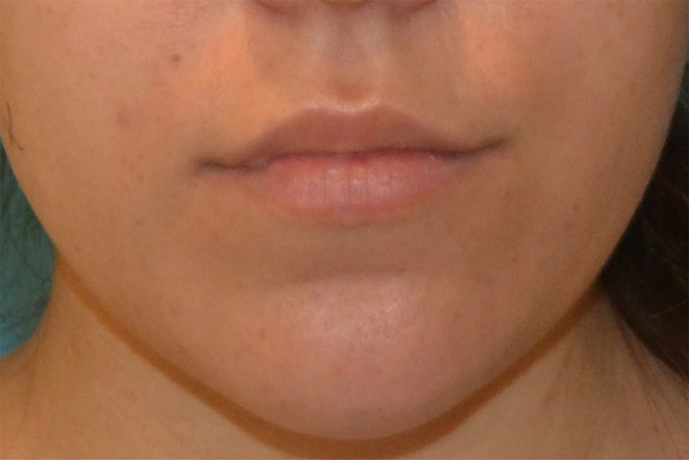 Facial Filler Real Patient Results by Dr. Scott Urban in Salt Lake City, Utah