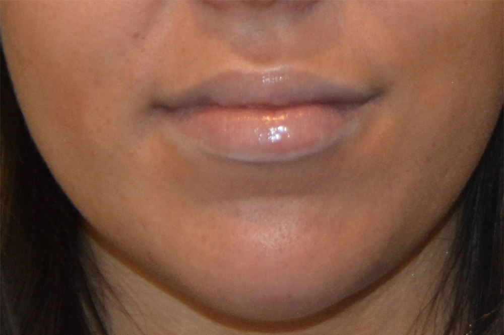 Facial Filler Real Patient Results by Dr. Scott Urban in Salt Lake City, Utah