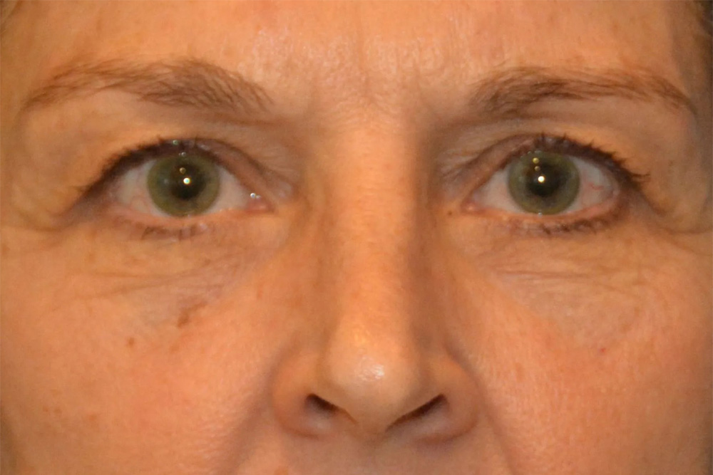 Facial Filler Real Patient Results by Dr. Scott Urban in Salt Lake City, Utah