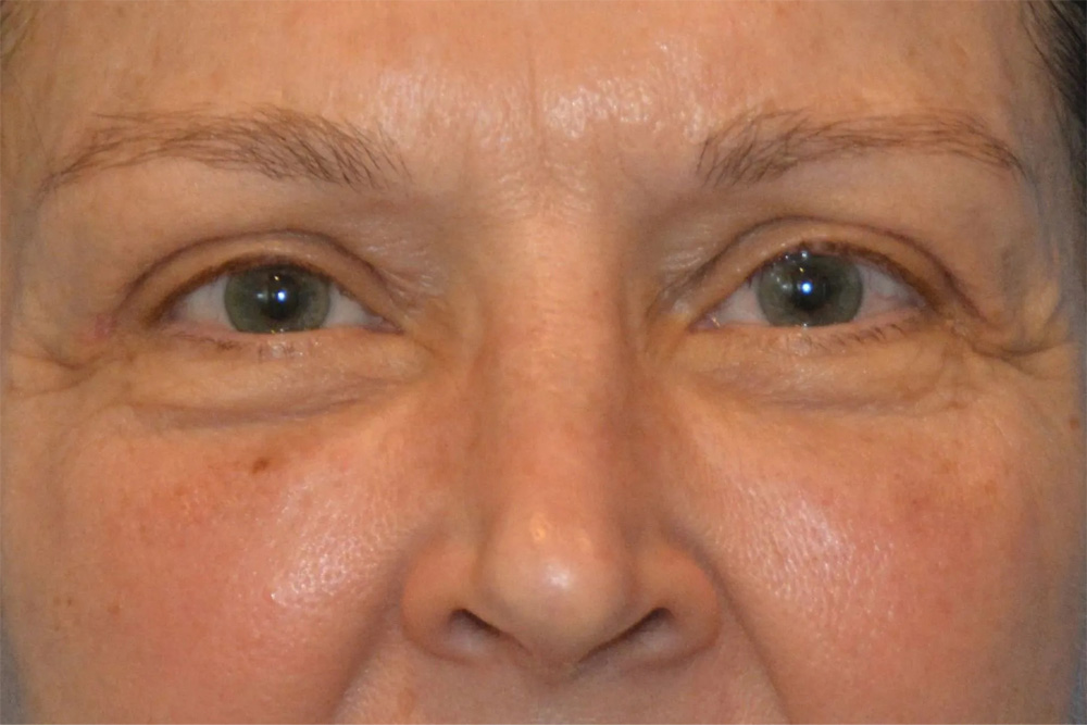 Facial Filler Real Patient Results by Dr. Scott Urban in Salt Lake City, Utah