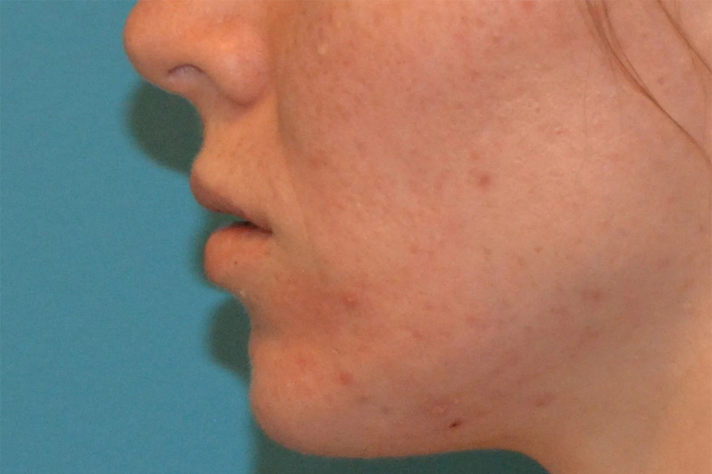 Facial Filler Real Patient Results by Dr. Scott Urban in Salt Lake City, Utah