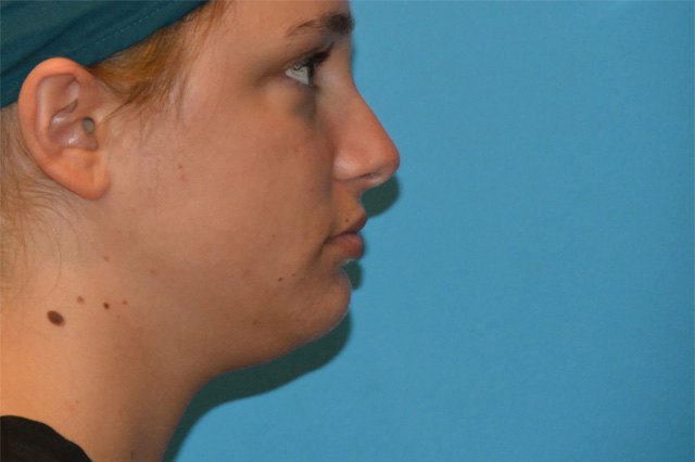 Jaw Surgery Real Patient Results by Dr. Scott Urban in Salt Lake City, Utah