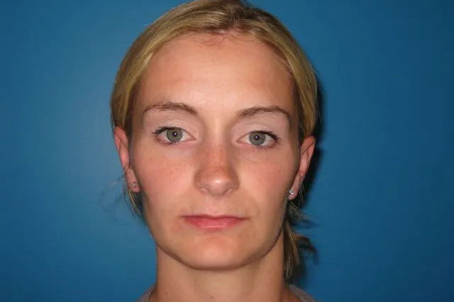 Jaw Surgery Real Patient Results by Dr. Scott Urban in Salt Lake City, Utah