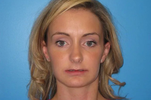 Jaw Surgery Real Patient Results by Dr. Scott Urban in Salt Lake City, Utah