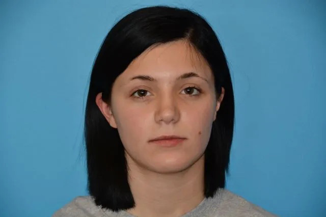 Jaw Surgery Real Patient Results by Dr. Scott Urban in Salt Lake City, Utah