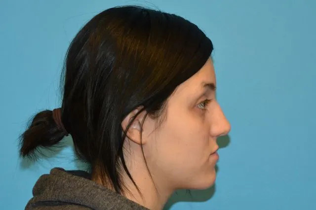 Jaw Surgery Real Patient Results by Dr. Scott Urban in Salt Lake City, Utah