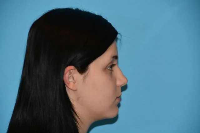 Jaw Surgery Real Patient Results by Dr. Scott Urban in Salt Lake City, Utah
