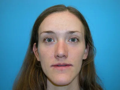 Jaw Surgery Real Patient Results by Dr. Scott Urban in Salt Lake City, Utah