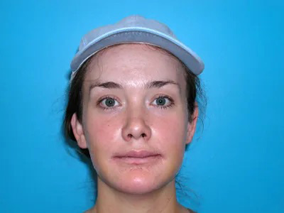 Jaw Surgery Real Patient Results by Dr. Scott Urban in Salt Lake City, Utah