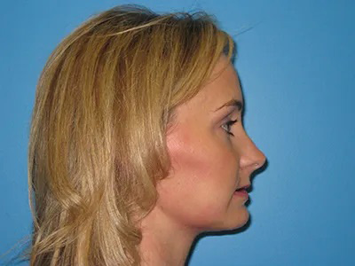 Jaw Surgery Real Patient Results by Dr. Scott Urban in Salt Lake City, Utah