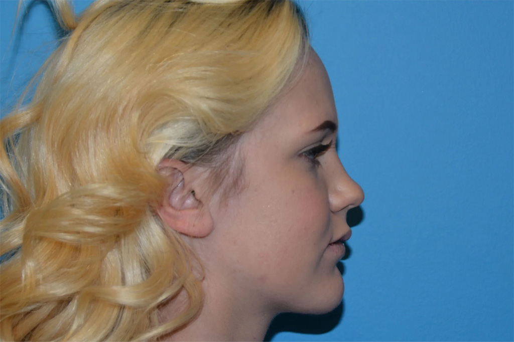 Jaw Surgery Real Patient Results by Dr. Scott Urban in Salt Lake City, Utah