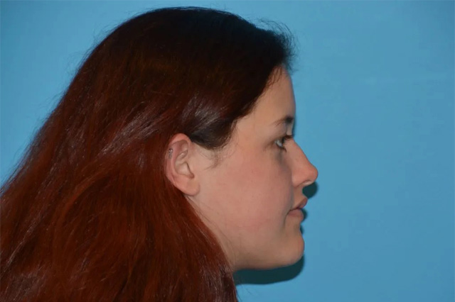 Jaw Surgery Real Patient Results by Dr. Scott Urban in Salt Lake City, Utah