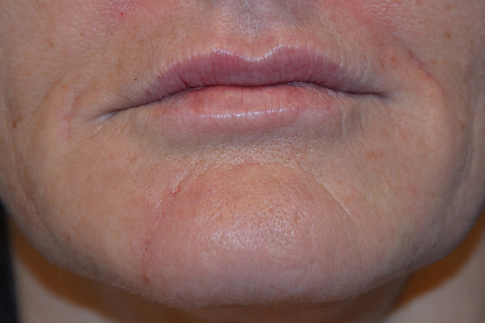 Lip Augmentation Real Patient Results by Dr. Scott Urban in Salt Lake City, Utah