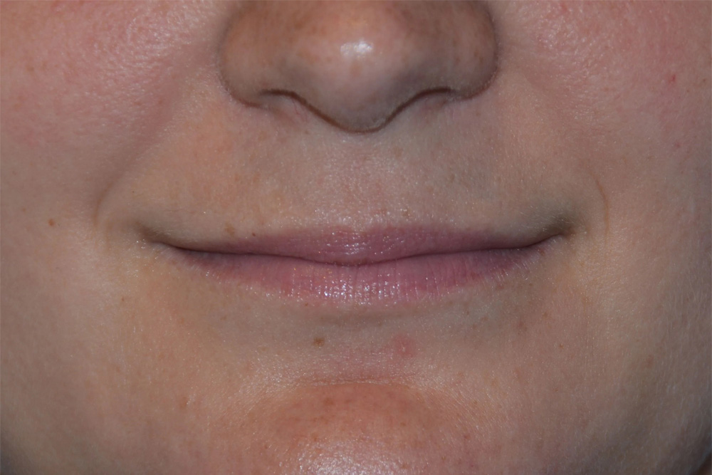 Lip Augmentation Real Patient Results by Dr. Scott Urban in Salt Lake City, Utah