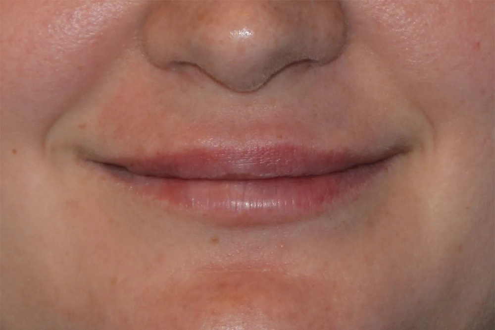 Lip Augmentation Real Patient Results by Dr. Scott Urban in Salt Lake City, Utah
