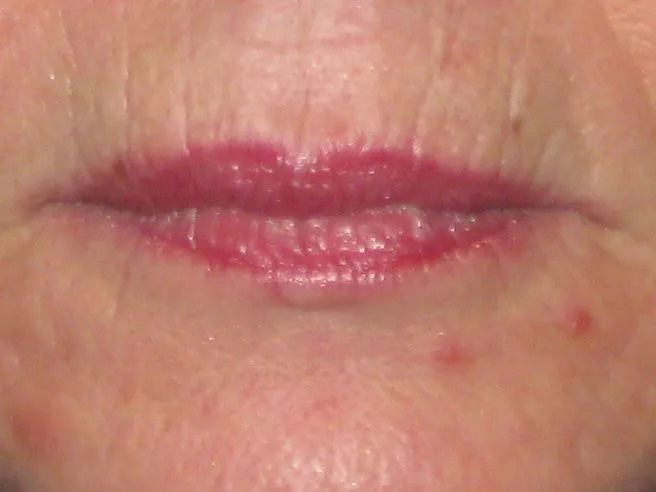 Lip Implant Real Patient Results by Dr. Scott Urban in Salt Lake City, Utah