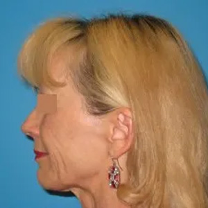 Beautify-Life Lift Real Patient Results by Dr. Scott Urban in Salt Lake City, Utah