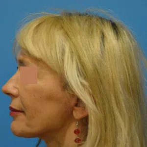 Beautify-Life Lift Real Patient Results by Dr. Scott Urban in Salt Lake City, Utah