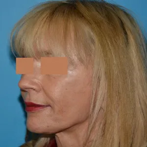 Beautify-Life Lift Real Patient Results by Dr. Scott Urban in Salt Lake City, Utah