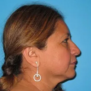 Beautify-Life Lift Real Patient Results by Dr. Scott Urban in Salt Lake City, Utah