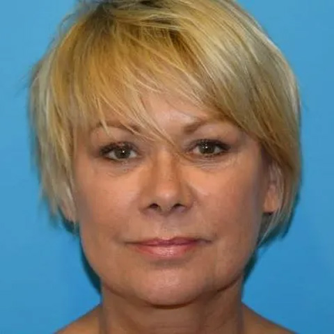 Beautify-Life Lift Real Patient Results by Dr. Scott Urban in Salt Lake City, Utah