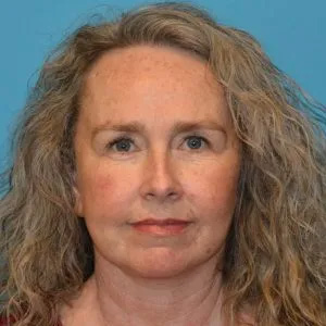 Beautify-Life Lift Real Patient Results by Dr. Scott Urban in Salt Lake City, Utah