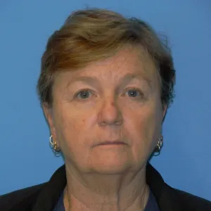 Beautify-Life Lift Real Patient Results by Dr. Scott Urban in Salt Lake City, Utah