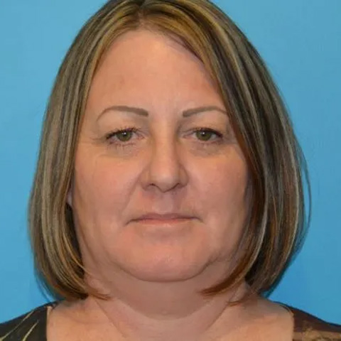 Beautify-Life Lift Real Patient Results by Dr. Scott Urban in Salt Lake City, Utah