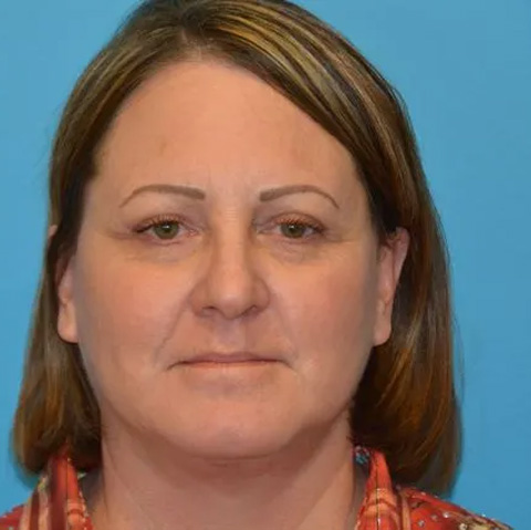 Beautify-Life Lift Real Patient Results by Dr. Scott Urban in Salt Lake City, Utah