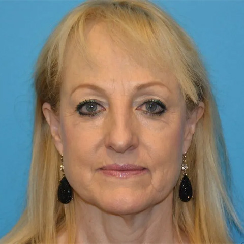 Beautify-Life Lift Real Patient Results by Dr. Scott Urban in Salt Lake City, Utah