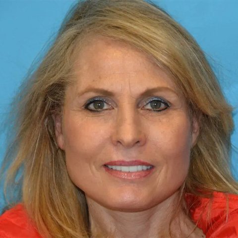 Beautify-Life Lift Real Patient Results by Dr. Scott Urban in Salt Lake City, Utah