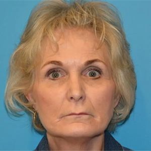 Beautify-Life Lift Real Patient Results by Dr. Scott Urban in Salt Lake City, Utah