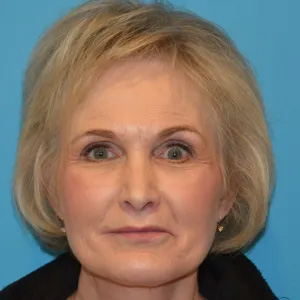 Beautify-Life Lift Real Patient Results by Dr. Scott Urban in Salt Lake City, Utah