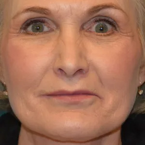 Beautify-Life Lift Real Patient Results by Dr. Scott Urban in Salt Lake City, Utah