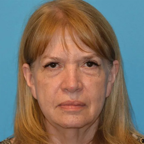 Beautify-Life Lift Real Patient Results by Dr. Scott Urban in Salt Lake City, Utah