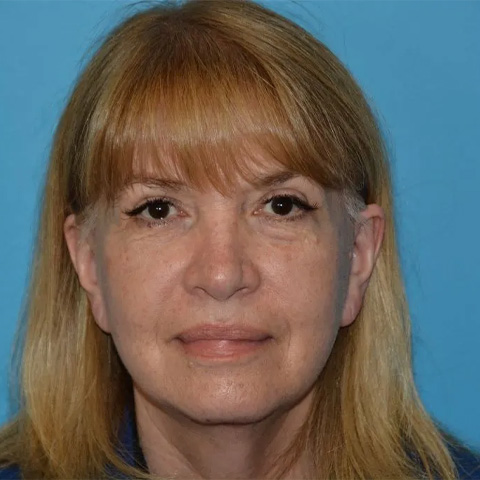 Beautify-Life Lift Real Patient Results by Dr. Scott Urban in Salt Lake City, Utah