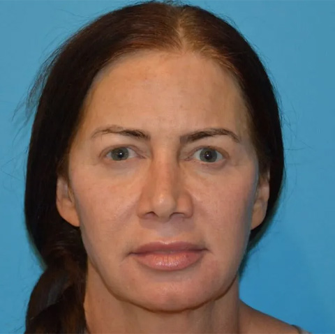 Beautify-Life Lift Real Patient Results by Dr. Scott Urban in Salt Lake City, Utah